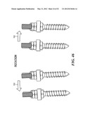 SPINAL PROSTHESIS AND FACET JOINT PROSTHESIS diagram and image