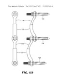 SPINAL PROSTHESIS AND FACET JOINT PROSTHESIS diagram and image