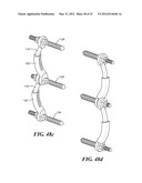 SPINAL PROSTHESIS AND FACET JOINT PROSTHESIS diagram and image