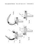 KNEE JOINT PROSTHESIS AND RELATED METHOD diagram and image