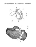 KNEE JOINT PROSTHESIS AND RELATED METHOD diagram and image