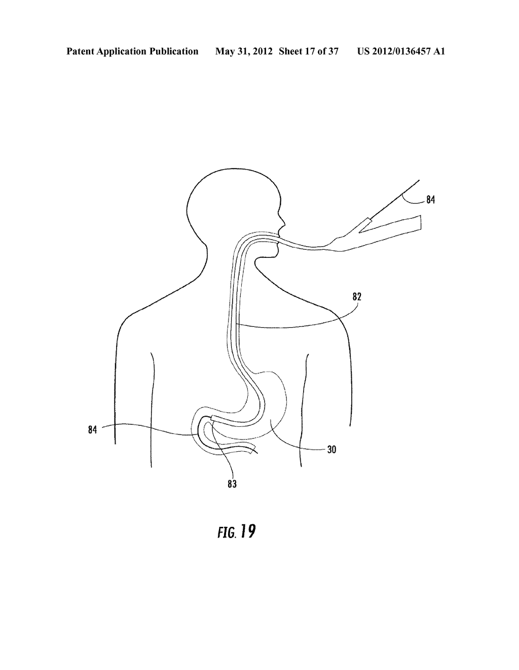 PYLORIC VALVE DEVICES AND METHODS - diagram, schematic, and image 18