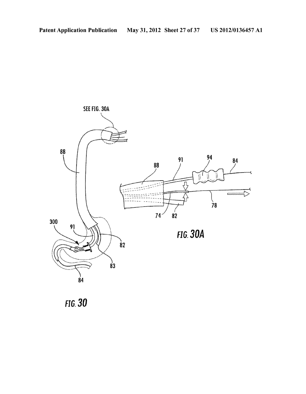 PYLORIC VALVE DEVICES AND METHODS - diagram, schematic, and image 28