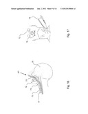 DILATOR ASSEMBLY, A DEVICE FOR FACILITATING TRACHEOSTOMY AND METHODS OF     MAKING A PERCUTANEOUS TRACHEOSTOMA diagram and image