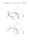 DILATOR ASSEMBLY, A DEVICE FOR FACILITATING TRACHEOSTOMY AND METHODS OF     MAKING A PERCUTANEOUS TRACHEOSTOMA diagram and image