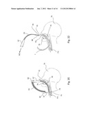 DILATOR ASSEMBLY, A DEVICE FOR FACILITATING TRACHEOSTOMY AND METHODS OF     MAKING A PERCUTANEOUS TRACHEOSTOMA diagram and image