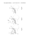 DILATOR ASSEMBLY, A DEVICE FOR FACILITATING TRACHEOSTOMY AND METHODS OF     MAKING A PERCUTANEOUS TRACHEOSTOMA diagram and image