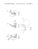 DILATOR ASSEMBLY, A DEVICE FOR FACILITATING TRACHEOSTOMY AND METHODS OF     MAKING A PERCUTANEOUS TRACHEOSTOMA diagram and image