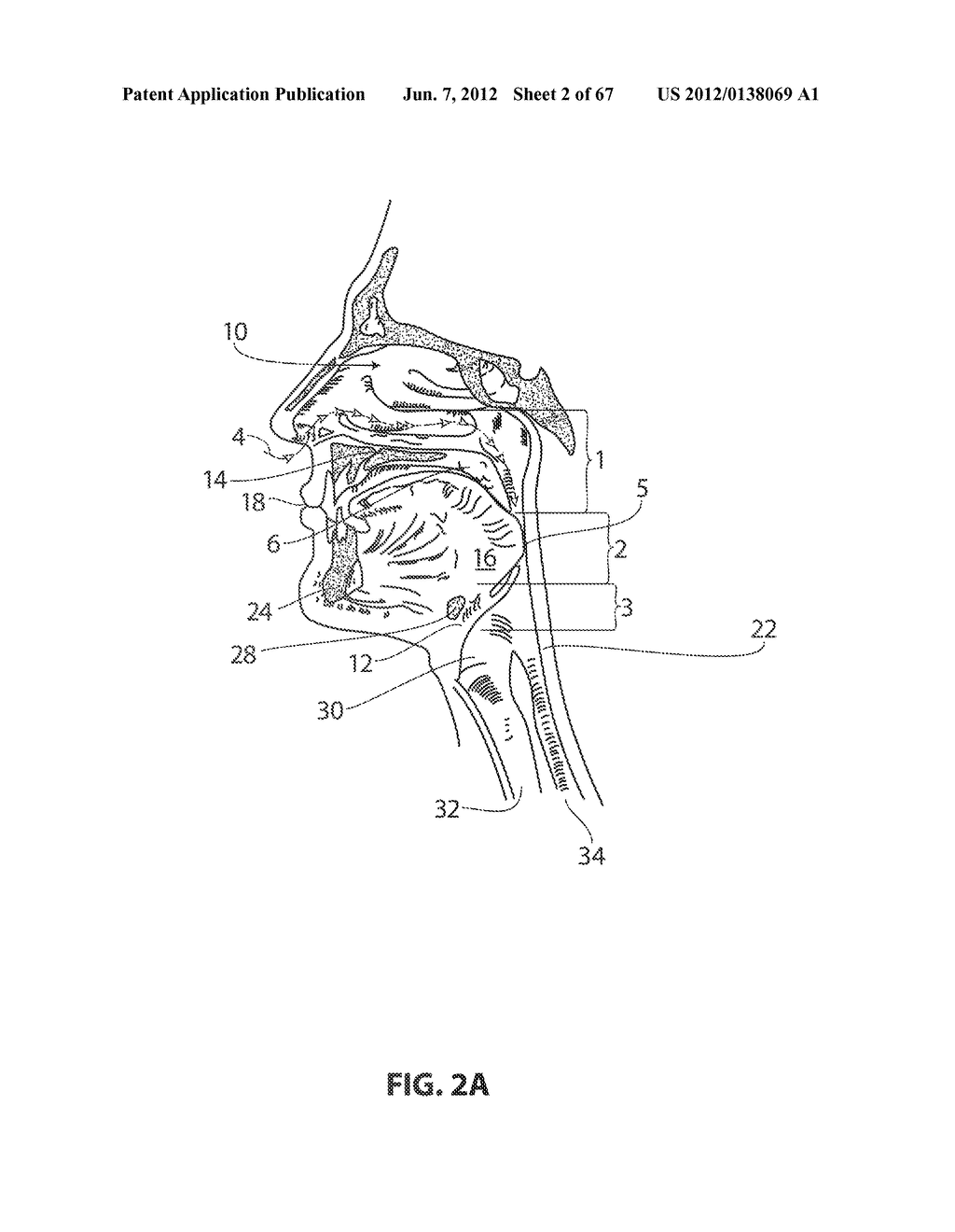 SYSTEMS AND METHODS FOR TREATMENT OF SLEEP APNEA - diagram, schematic, and image 03