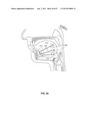 SYSTEMS AND METHODS FOR TREATMENT OF SLEEP APNEA diagram and image