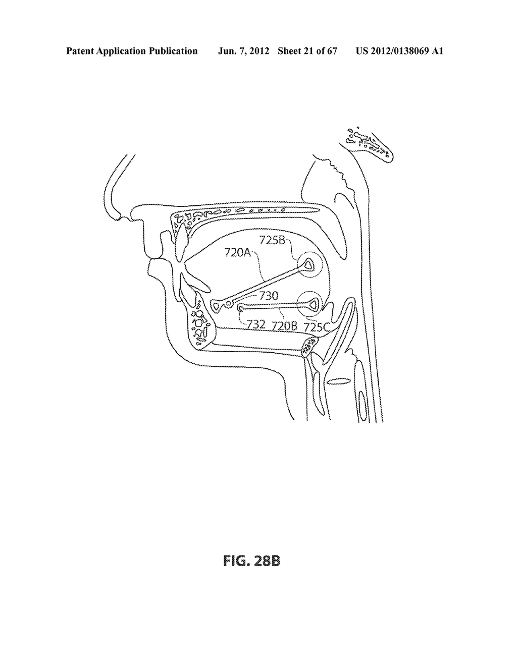 SYSTEMS AND METHODS FOR TREATMENT OF SLEEP APNEA - diagram, schematic, and image 22