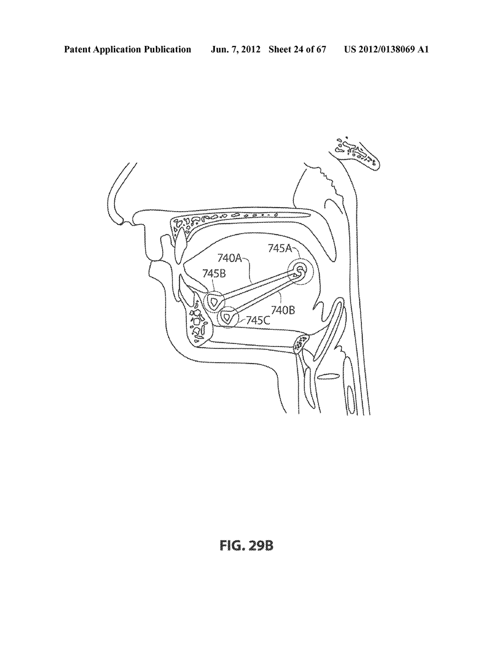 SYSTEMS AND METHODS FOR TREATMENT OF SLEEP APNEA - diagram, schematic, and image 25