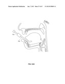 SYSTEMS AND METHODS FOR TREATMENT OF SLEEP APNEA diagram and image