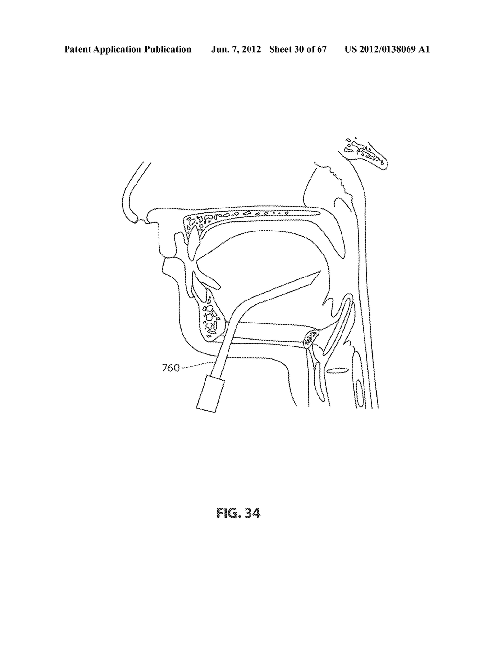 SYSTEMS AND METHODS FOR TREATMENT OF SLEEP APNEA - diagram, schematic, and image 31