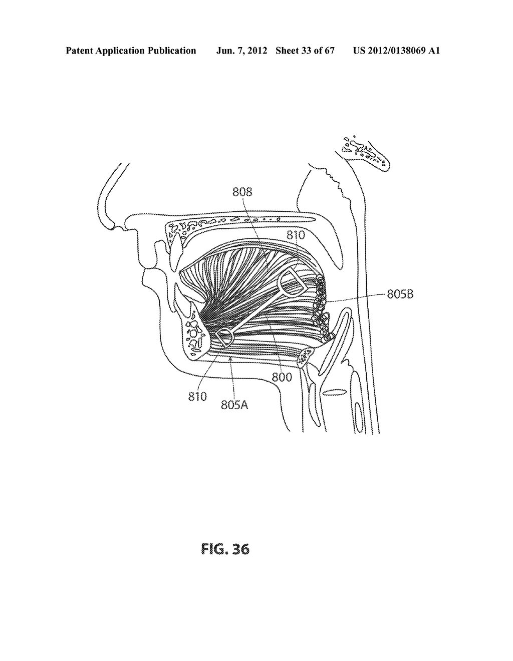 SYSTEMS AND METHODS FOR TREATMENT OF SLEEP APNEA - diagram, schematic, and image 34