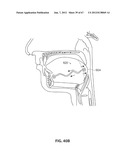 SYSTEMS AND METHODS FOR TREATMENT OF SLEEP APNEA diagram and image