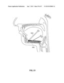 SYSTEMS AND METHODS FOR TREATMENT OF SLEEP APNEA diagram and image