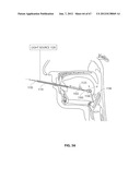 SYSTEMS AND METHODS FOR TREATMENT OF SLEEP APNEA diagram and image