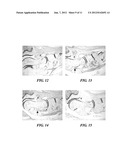 ANTIFOLATE COMBINATIONS diagram and image