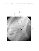 RADIOPAQUE CANNULA MARKER diagram and image