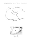 SYSTEM AND METHOD FOR FACIAL NERVE MONITORING DURING FACIAL SURGERY diagram and image