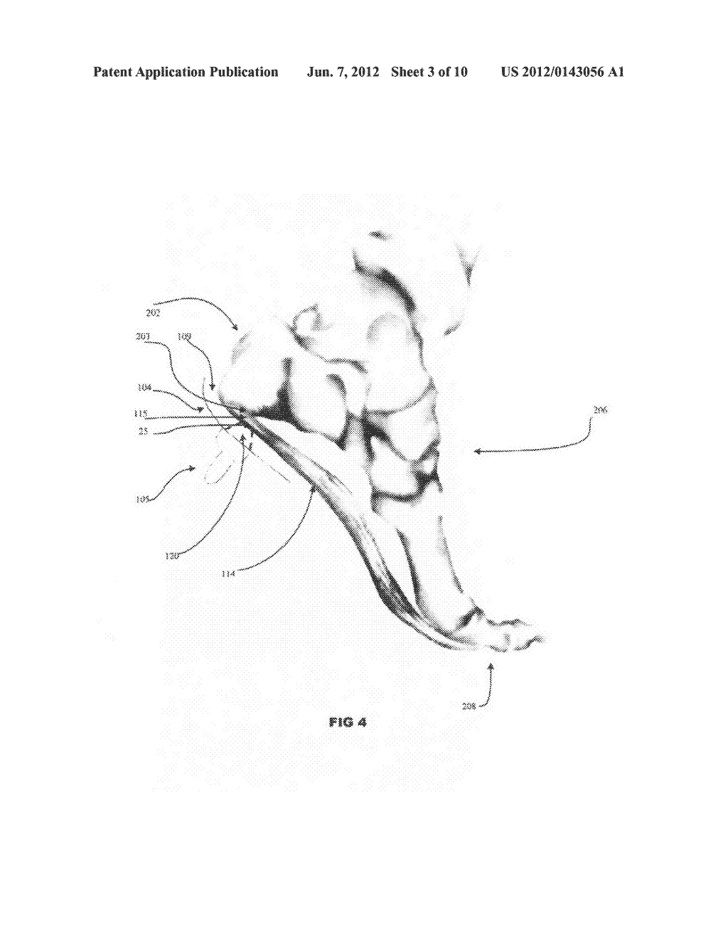 Methods and systems for treating plantar fascia - diagram, schematic, and image 04