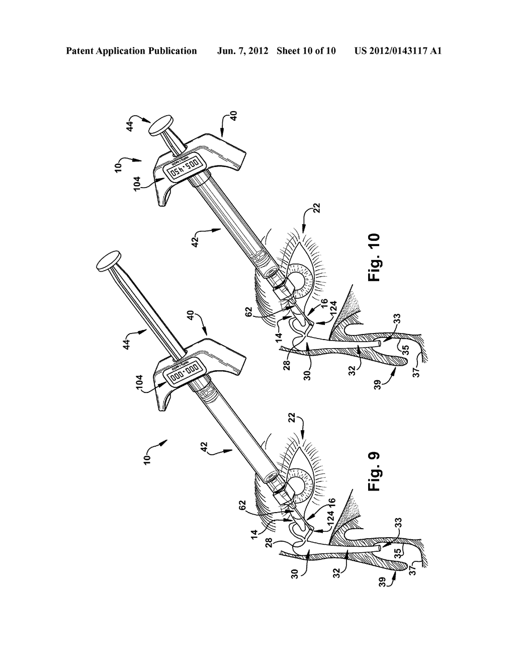 LACRIMAL DRAINAGE MANOMETER AND METHOD OF USE - diagram, schematic, and image 11