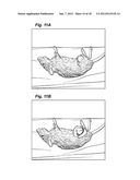 METHOD AND DEVICE FOR TREATING MICROSCOPIC TUMORS REMAINING IN TISSUES     FOLLOWING SURGICAL RESECTION diagram and image