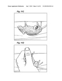 METHOD AND DEVICE FOR TREATING MICROSCOPIC TUMORS REMAINING IN TISSUES     FOLLOWING SURGICAL RESECTION diagram and image