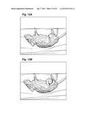 METHOD AND DEVICE FOR TREATING MICROSCOPIC TUMORS REMAINING IN TISSUES     FOLLOWING SURGICAL RESECTION diagram and image