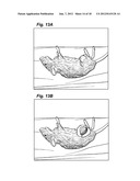 METHOD AND DEVICE FOR TREATING MICROSCOPIC TUMORS REMAINING IN TISSUES     FOLLOWING SURGICAL RESECTION diagram and image