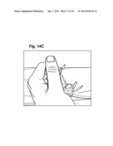 METHOD AND DEVICE FOR TREATING MICROSCOPIC TUMORS REMAINING IN TISSUES     FOLLOWING SURGICAL RESECTION diagram and image