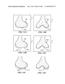 Surgical Tools for Arthroplasty diagram and image