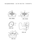 Surgical Tools for Arthroplasty diagram and image