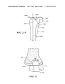 Surgical Tools for Arthroplasty diagram and image