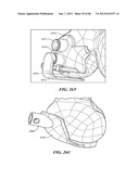 Surgical Tools for Arthroplasty diagram and image