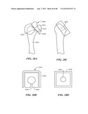 Surgical Tools for Arthroplasty diagram and image