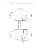 Surgical Tools for Arthroplasty diagram and image