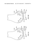 Surgical Tools for Arthroplasty diagram and image