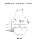 Surgical Tools for Arthroplasty diagram and image