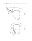 Surgical Tools for Arthroplasty diagram and image