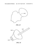 Surgical Tools for Arthroplasty diagram and image