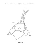 Surgical Tools for Arthroplasty diagram and image