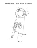 Surgical Tools for Arthroplasty diagram and image