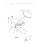 Surgical Tools for Arthroplasty diagram and image