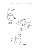 POSITIONING GUIDE AND A FEMUR BONE CUTTING GUIDE SYSTEM diagram and image