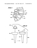 Facet Arthroplasty Devices and Methods diagram and image