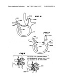 Facet Arthroplasty Devices and Methods diagram and image