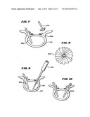 Facet Arthroplasty Devices and Methods diagram and image