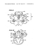 Facet Arthroplasty Devices and Methods diagram and image